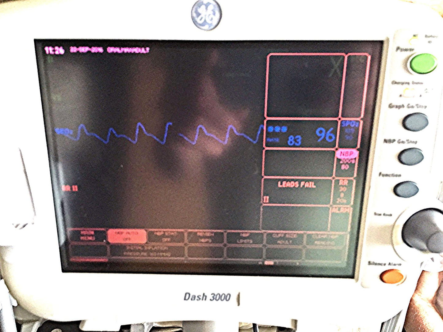 GE DASH 3000 Vital Signs Monitor & STAND LEADS CUFF OXIMETER PRINTER WATCHVIDEO